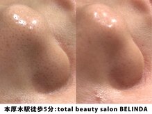 ベリンダ(BELINDA)/毛穴洗浄ハイドロスプラッシュ