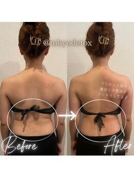 東京デトックス/ブライダルエステ~背中二の腕~