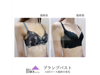 バイオビューティー 神戸本店(Bio Beauty)/プランプバスト　12回コース症例