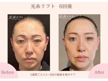 クオーレ ハギワラ(cuore HAGIWARA)/光糸リフト