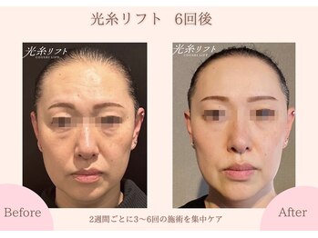 クオーレ ハギワラ(cuore HAGIWARA)/光糸リフト