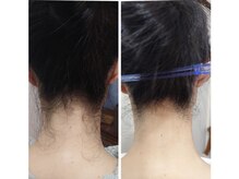 コンフィルーム(comfy room)/襟足脱毛