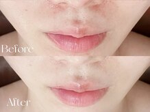 ウィハナ(wehana)/【ララピール】くすみ/赤み/毛穴