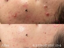 サロンヴェアリー 広尾(salon vary)/肌管理　#ニキビケア#肌管理