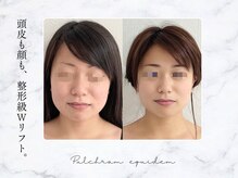 プルチャームエクイデム(Pulchram equidem)