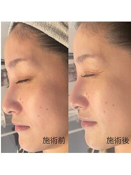 エムアンドユウ(m&u)/毛穴洗浄でトーンアップ