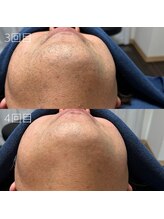 カナウ(KANAU)/ヒゲ脱毛（40代前半男性）