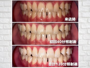 ライトビューティー 関内店(LIGHT BEAUTY)の写真/圧倒的効果のホワイトニング技術☆最高濃度溶液＋高出力マシンで最短一週間で理想の白さに！