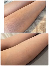 エクラ(eclat)/レディースひざ下脱毛