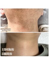 フェリス(FELIZ)/人気のヒゲ脱毛