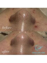 シャロンドットエイチエム(CHALON.HM)/韓国式毛穴洗浄