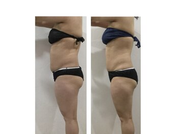 レミュー/全身ダイエット症例