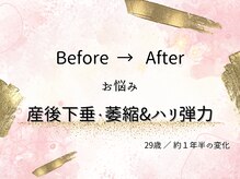 ロットプラス(Lot Plus)/バストアップ症例【F→Gカップ】