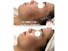 サラ 恵比寿店(SARA)/４フォトRF ニキビケア