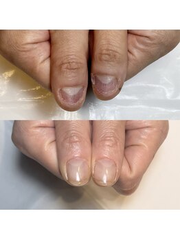 キュア(Cure.)/男性のお客様の深爪緩和