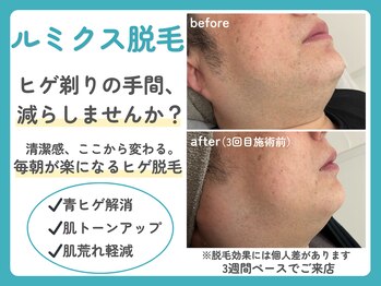 トッコ 那須塩原店(tocco)の写真/メンズにもおすすめ！ルミクス脱毛で好印象を♪清潔感あふれる素肌を目指して◎ 