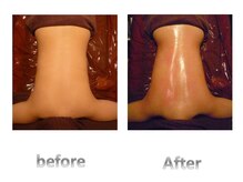 ブルーム ラグジュアリー 町田店(BLOOM luxury)/背中スッキリ美人ケア