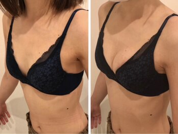 リール 恵比寿店(RIRE)/バストアップ症例【広尾恵比寿】