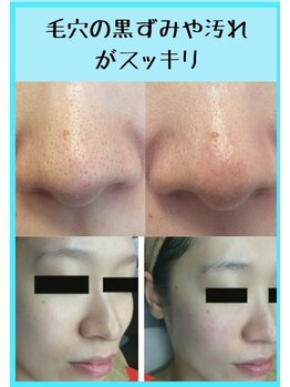 ビーフィール 千葉店(be feel)/ハイドロスキンで毛穴洗浄