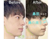 ラプリ 横浜店(Raplit)/隆鼻＋輪郭矯正40分