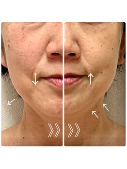 レモンローズ(Lemon Rose)/高周波小顔フェイシャル