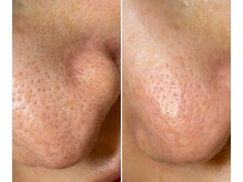 サイ(Sai)/before⇒after