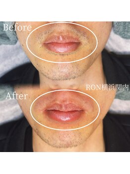 サロンロン 横浜関内(SALON RON)/口周りのヒゲ脱毛
