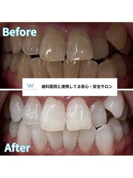 ホワイトニングショップ 豊田店(WHITENING SHOP)/圧倒的効果!セルフホワイトング