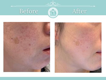 シミケアゼロ美人 表参道店(シミケアZERO美人)/【シミケア★シミゼロ症例】