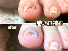 巻き爪補正と一緒にジェルやマニキュアも施せます♪