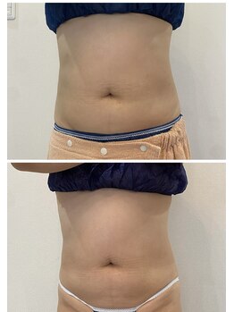 レミュ(Remu)/最新機器で脂肪撃退