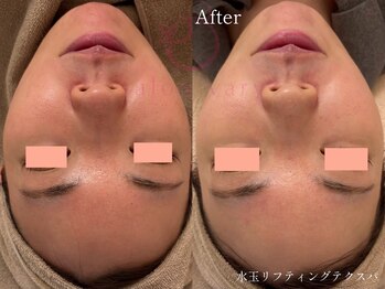 サロンヴェアリー 広尾(salon vary)/敏感肌、酒さの方にも！