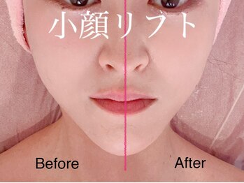 アンド(AND/&)/小顔リフト