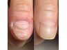 自爪育成｜爪周りの皮膚改善｜トラブルで正常な爪が生えなくなってしまった方