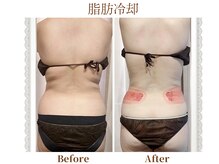 モテスリム/脂肪冷却 腰2カップ