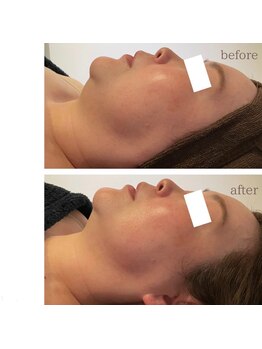 フェアリー/二重あごも綺麗に★