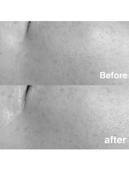 ミノア 大野城店(MINOA)/光フェイシャル/シミ・シワ改善