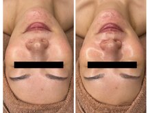 エクラルム(Eclaleum)/BeforeAfter　ララピール