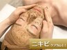 New☆剥離なしハーブピーリング｜ニキビケア/赤み/肌荒れ◎¥15,400→¥8,800