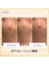 ウィズリリナ 新横浜(with Lilina.)/1回/毛穴洗浄/ハイドラ/新横浜