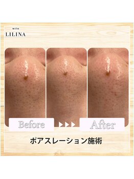 ウィズリリナ 新横浜(with Lilina.)/1回/毛穴洗浄/ハイドラ/新横浜