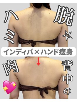 アディス 心斎橋(ADISE)/インディバ×ハンド痩身！