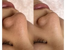 22クラレ(22curare)/毛穴もキレイに♪美素肌エステ