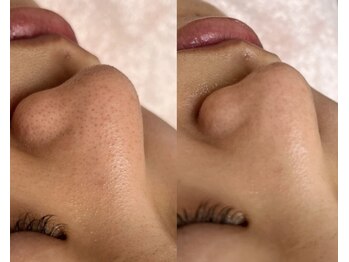 22クラレ(22curare)/毛穴もキレイに♪美素肌エステ