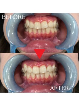 ボリューミー(Volum-me)/継続して施術することで効果見え