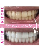 エクシアホワイトニング 西尾店/ビフォーアフター