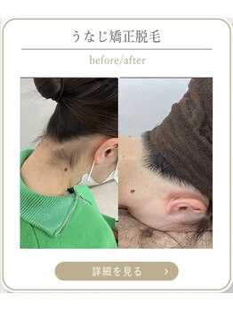 ミース 上野店/お客様のうなじ変化♪