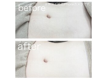 ラクシー 北千住(luxssy)/お腹シェービング