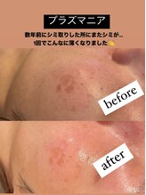 ビューティーネイル(Beauty Nail)/プラズマニア