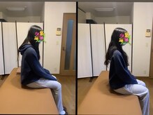 ヴィバランス(Vebalance)の雰囲気（猫背・骨盤矯正　左ビフォー　右アフター）